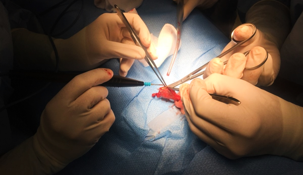 Actualizan criterios para la lista de espera de trasplante hepático: qué cambia