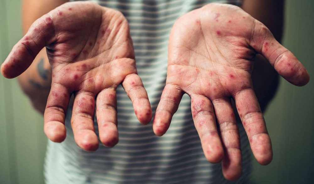 Alerta virus del sarampión en circulación