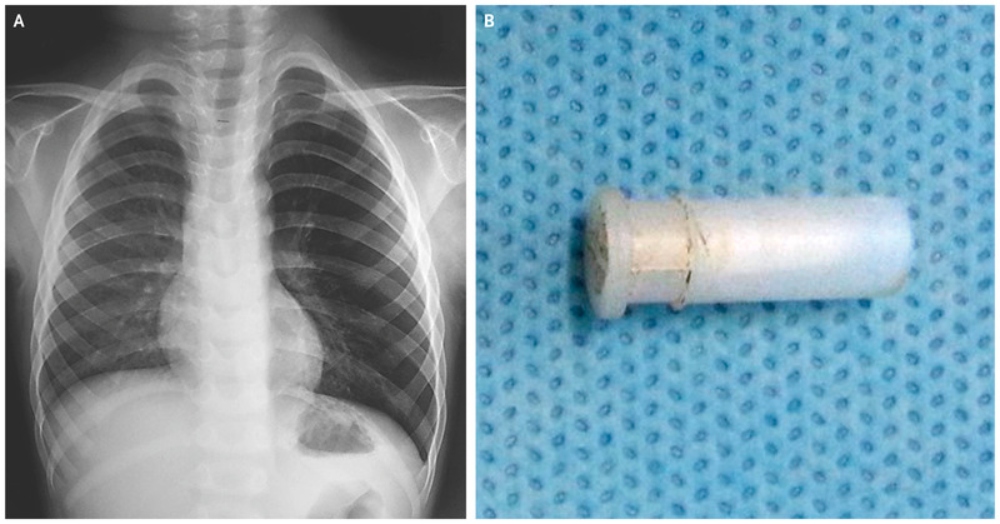 VIDEO: nene se tragó un silbato y terminó tosiendo “raro”