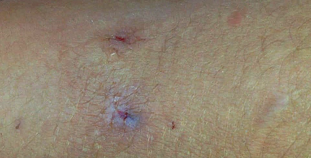 Nadaba en El Brete cuando algo lo mordió