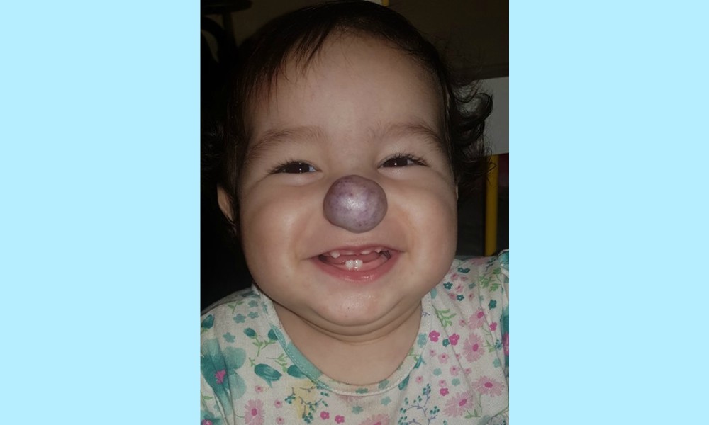 “Todos por Leah”, la niña de un año con hemangioma