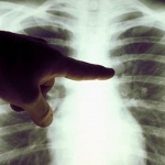 Cáncer de pulmón