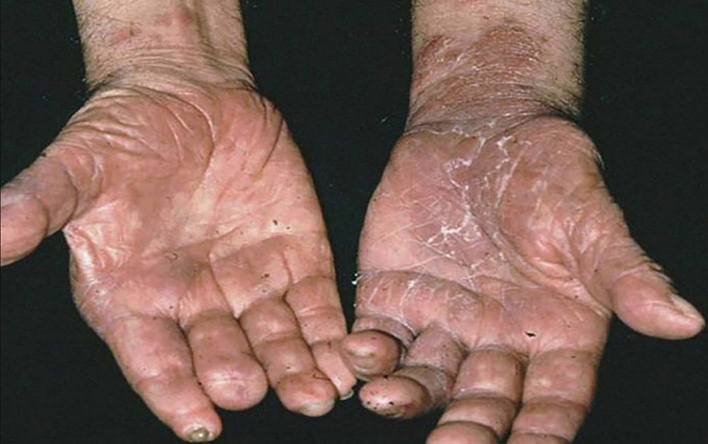 Hoy se conmemora el Día Mundial contra la Lepra