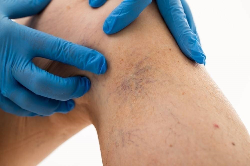 Várices y “arañitas” cada vez afectan a mujeres más jóvenes