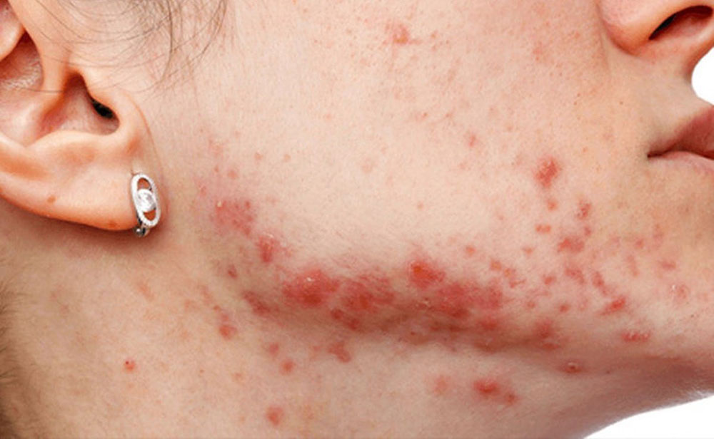 Misiones se unió a la campaña de detección de hidradenitis supurativa