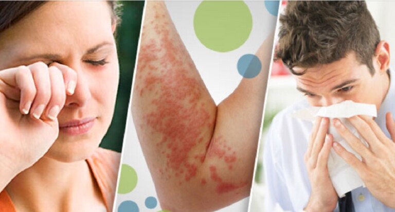 Día Internacional de las Alergias: cuáles son las principales y las más ...