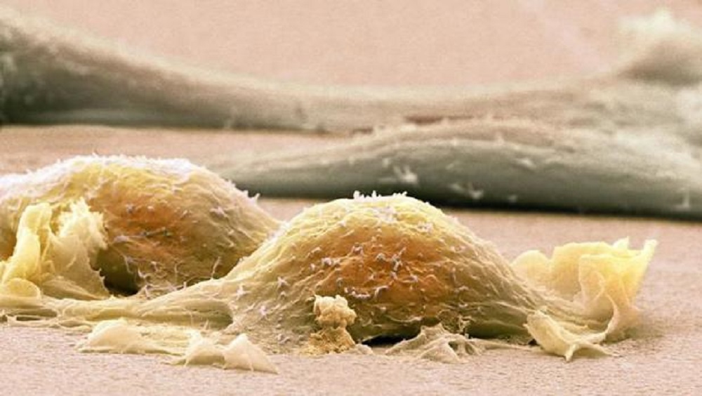 El sarcoma, un “enemigo silencioso” con más de 150 variedades