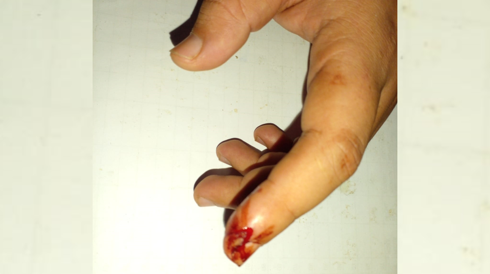 A mordiscos intentó evitar el arresto