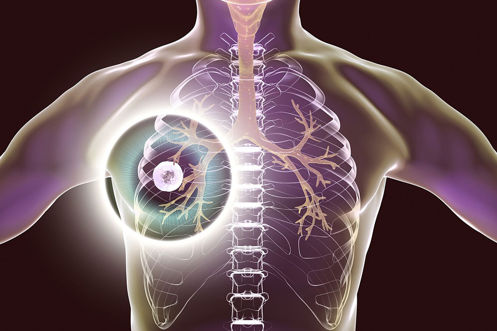 OMS: aumentaron las muertes por tuberculosis en el mundo