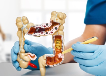Cáncer de colon: 40% de los pacientes con test positivo no se hace la colonoscopía