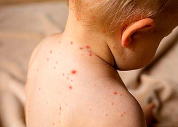 Buscan vacunar al 95% de los niños contra sarampión, rubéola, paperas y polio