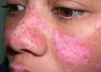 Por el clima de la región, “en Misiones se ve bastante la manifestación del lupus”