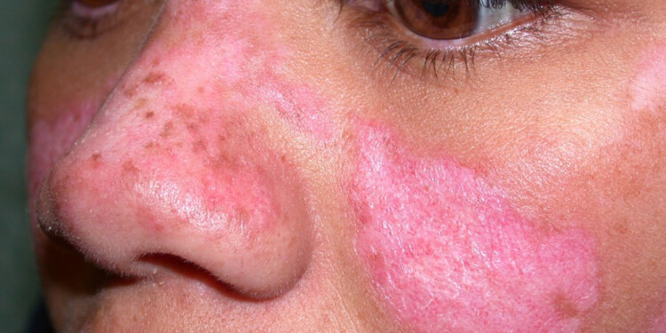 INCIDENCIA. Mayormente mujeres jóvenes presentan los síntomas de lupus, una enfermedad autoinmune.