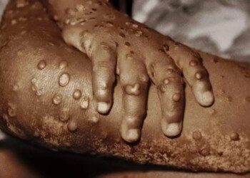 Alerta por aumento de casos de viruela del mono en humanos