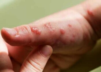 Desarrollan tres tests para detectar la viruela del mono