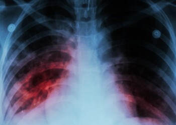 Murió una adolescente por tuberculosis en Corrientes