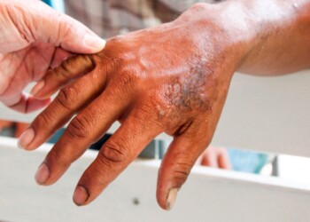 Lepra: en Misiones se detectaron siete nuevos pacientes en lo que va de 2022