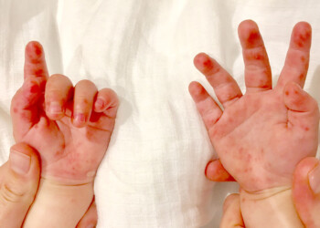 Aumentan las consultas pediátricas por casos de enfermedad de pie, mano y boca