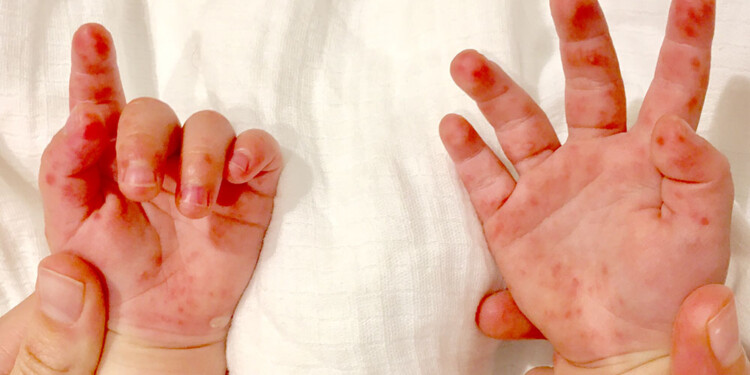 TRATAMIENTO. A pesar de no ser algo grave, resulta muy molesto para los niños por la sintomatología presente.