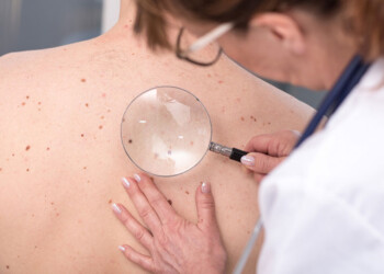 Melanoma, el tipo más peligroso de cáncer de piel
