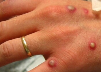 La viruela del mono estaría ya a pocos metros de Misiones