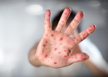 Confirman el primer caso sospechoso de viruela del mono en Argentina