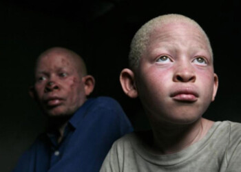 Albinismo: “Unidos para que se escuchen nuestras voces”