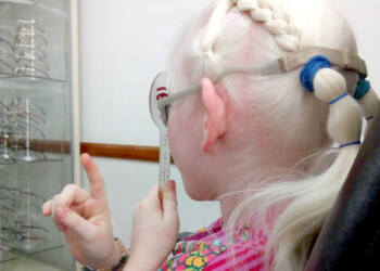 Albinismo: “Durante mucho tiempo hemos sido invisibles ante los ojos del Estado”