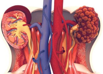 Día del Cáncer Renal: se producen 13 diagnósticos diarios en Argentina