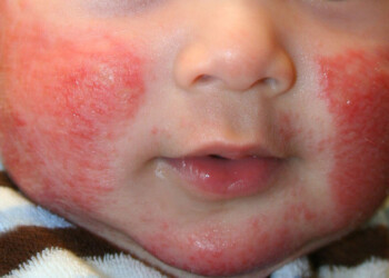 Dermatitis atópica: enfermedad crónica y de tratamiento costoso