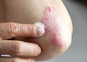 Buscan detectar a personas con enfermedad psoriásica sin tratar