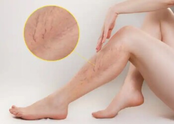 Las várices, una complicación frecuente en el embarazo