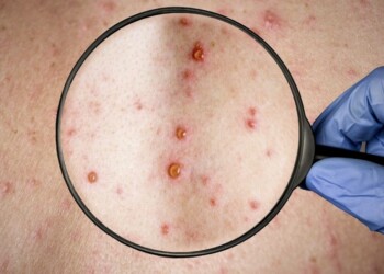 La OMS teme que la viruela del mono se instale en países no endémicos