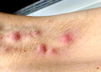 Darán turnos gratuitos en Misiones para la detección de la hidradenitis supurativa