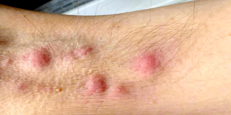 NO CONTAGIOSO. La HS es una enfermedad de origen infeccioso, dolorosa y con supuración.