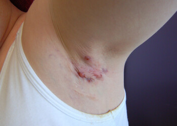 Hidradenitis Supurativa: cómo obtener turno para saber si la padecemos o no