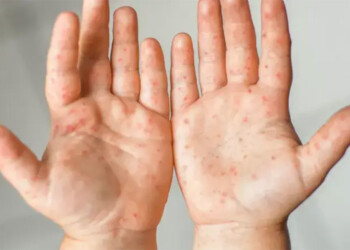 Viruela del mono: reportaron el primer muerto en Brasil y tres niños fueron diagnosticados