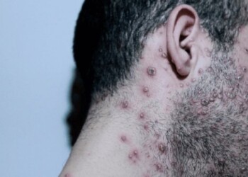 Cuál es el perfil más común de un afectado por la viruela del mono