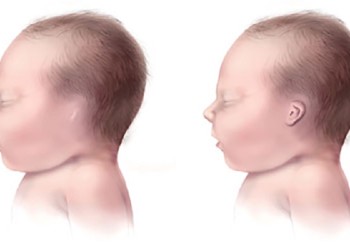 Estudian las causas de la microtia en Misiones: qué es y cómo afecta