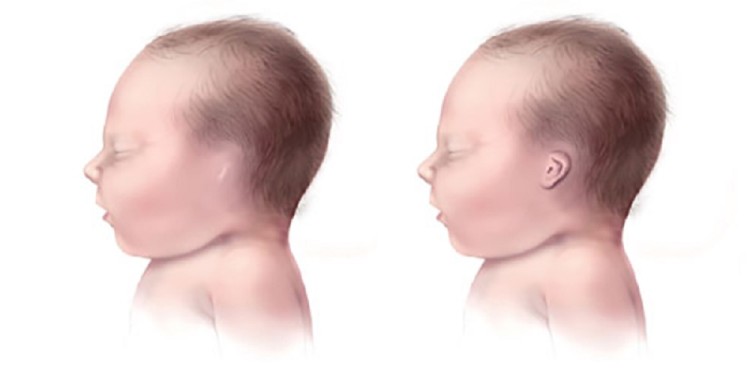 ENFERMEDAD. Se trata de una alteración que puede afectar a uno o los dos oídos.