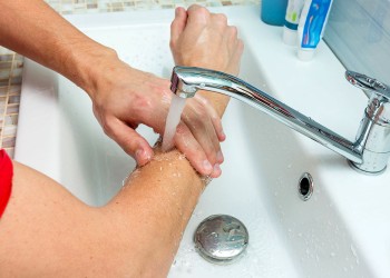 Quemaduras: “Cualquiera sea la causa, primero hay que poner la zona bajo el agua”