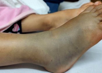 Prevención y cuidado por mordidas de serpientes en la temporada de verano