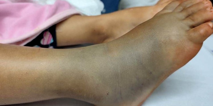 Ante la mordedura de una serpiente, Martínez recomienda llamar inmediatamente al 911. “Ellos están conectados con todo, incluso la Policía Ambiental siempre está en comunicación conmigo. Lo fundamental es que el accidentado llegue lo antes posible al hospital”, dijo.