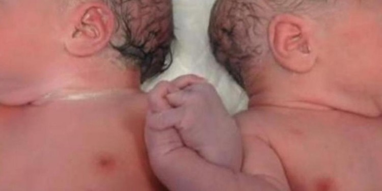 UNA NENA Y UN VARÓN. Los mellizos están en buen estado de salud y con peso noral para parto múltiple.