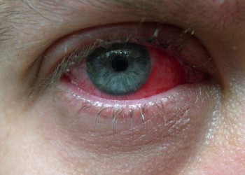Advierten por una conjuntivitis vinculada a la clamidia y la gonorrea