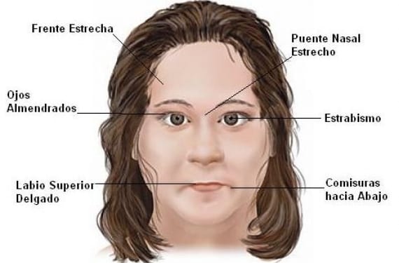Las principales características del síntoma de Angelman: Foto: Neurociencia 