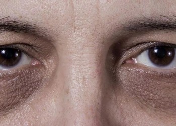 Remedios caseros para combatir las ojeras