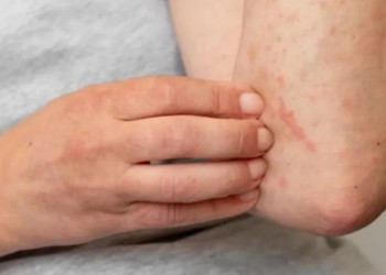 Dermatitis atópica: “Las enfermedades de la piel son crónicas, pero lo importante es saber que se tratan”