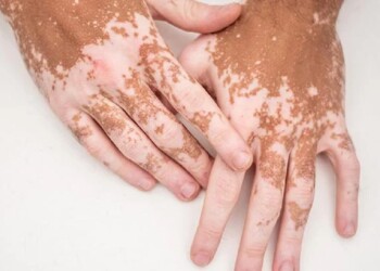 El riesgo de padecer depresión es 5 veces mayor en pacientes con vitiligo