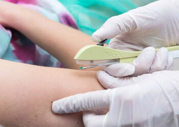 Misiones suma el acceso gratuito del anticonceptivo subdérmico de doble varilla